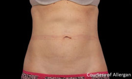 Coolsculpting