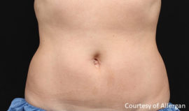 Coolsculpting