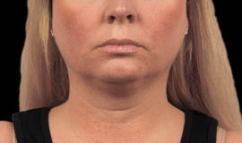 Coolsculpting