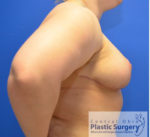 Breast Reduction/Breast Lift