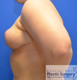 Breast Reduction/Breast Lift