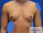 Breast Augmentation