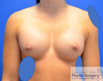 Breast Augmentation