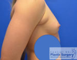 Breast Augmentation