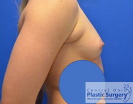 Breast Augmentation