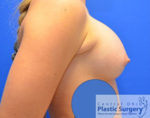 Breast Augmentation