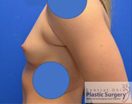 Breast Augmentation