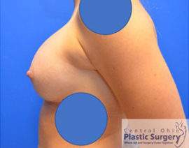 Breast Augmentation