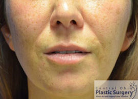 Injectable Fillers/Botox