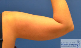 Coolsculpting Case 7094 After Photo Coolsculpting