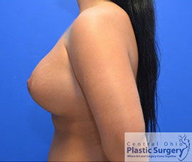 Breast Augmentation