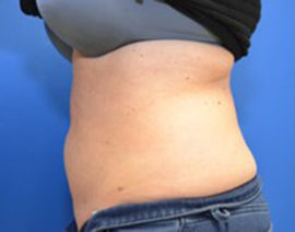 Coolsculpting