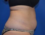 Coolsculpting