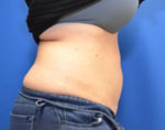 Coolsculpting