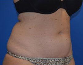 Coolsculpting