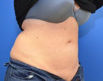 Coolsculpting