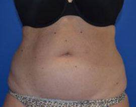 Coolsculpting