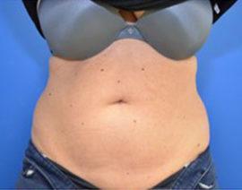 Coolsculpting