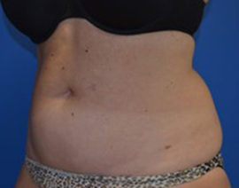 Coolsculpting