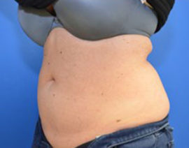 Coolsculpting