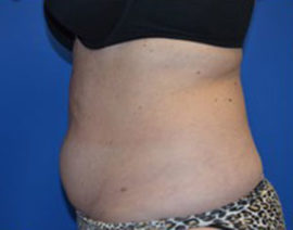 Coolsculpting