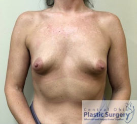 Breast Augmentation