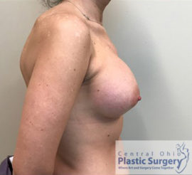 Breast Augmentation