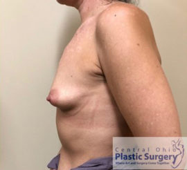 Breast Augmentation