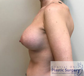 Breast Augmentation