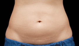 Coolsculpting