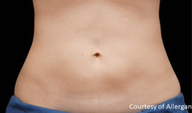 Coolsculpting