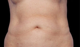 Coolsculpting