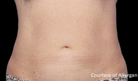 Coolsculpting