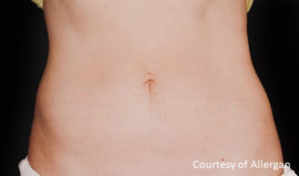 Coolsculpting