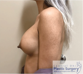 Breast Augmentation