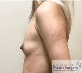 Breast Augmentation