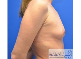 Breast Augmentation