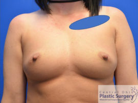 Breast Augmentation