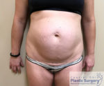 Tummy Tuck