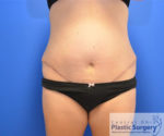 Tummy Tuck