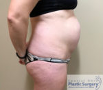 Tummy Tuck