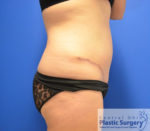 Tummy Tuck