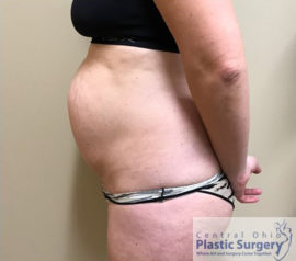 Tummy Tuck