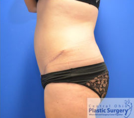 Tummy Tuck