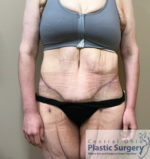 Tummy Tuck