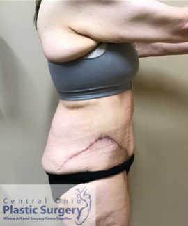 Tummy Tuck