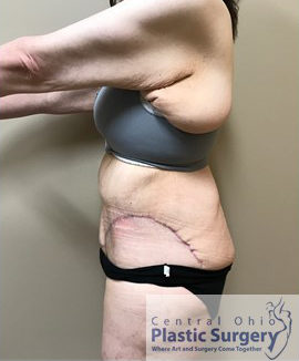 Tummy Tuck