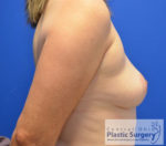 Breast Augmentation