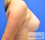 Breast Augmentation