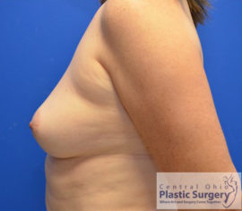 Breast Augmentation